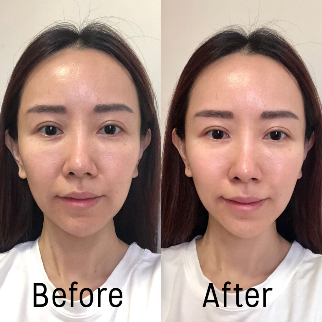 Eucerin® Hyaluron-Filler Treatment Review